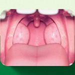 amígdalas e as adenoides - Clínica Regina Ortega