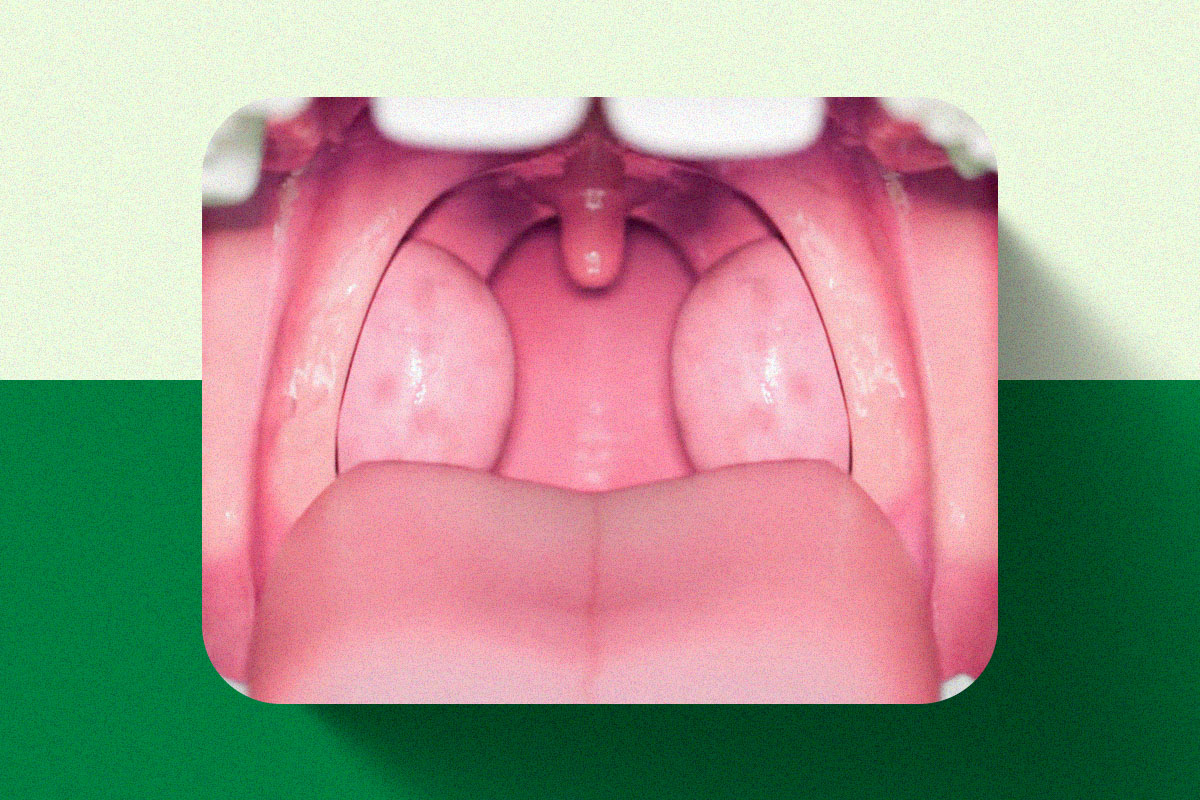 amígdalas e as adenoides - Clínica Regina Ortega